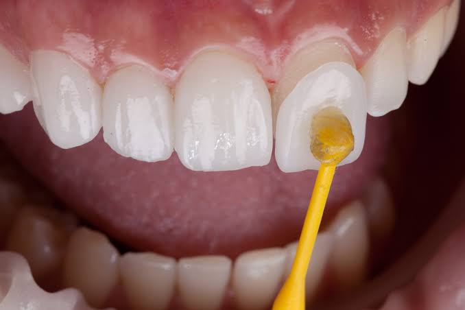 Dental veneers in Islamabad - Dr. Mahnoor Dental Clinic