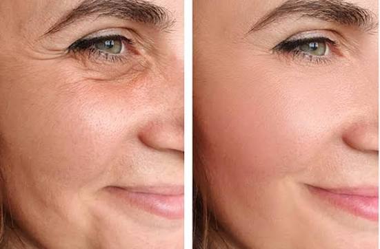 Non-Surgical Face Lift