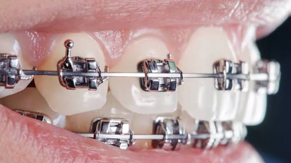 Orthodontics (Braces)
