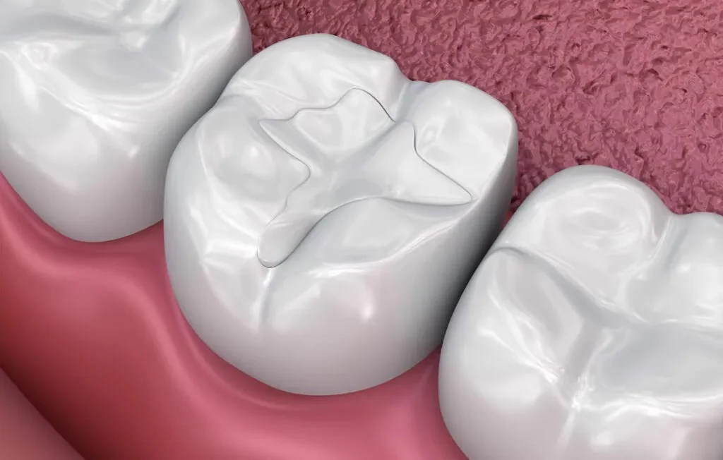 Tooth-colored fillings in Islamabad - Dr. Mahnoor Dental Clinic
