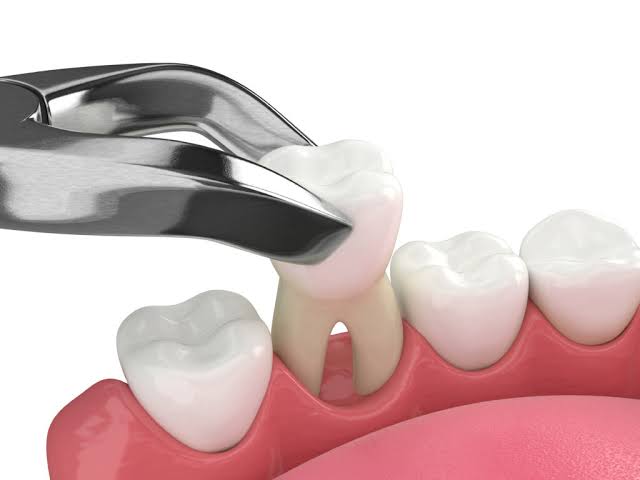 Tooth extraction in Islamabad - Dr. Mahnoor Dental Clinic