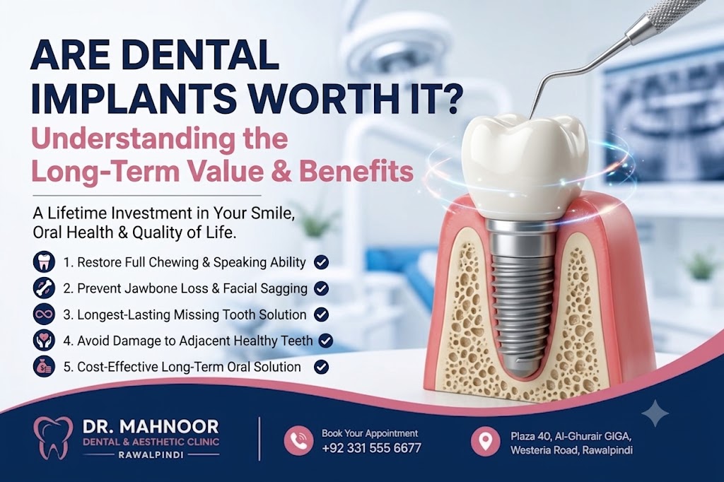 are dental implants worth it